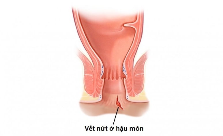 Nứt kẽ hậu môn - Ảnh minh họa 3