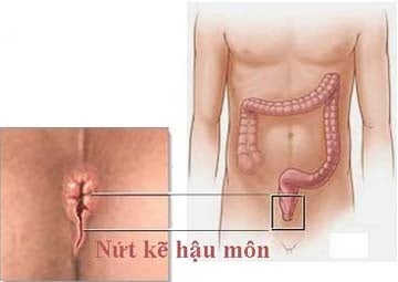 Nứt kẽ hậu môn - Ảnh minh họa 4