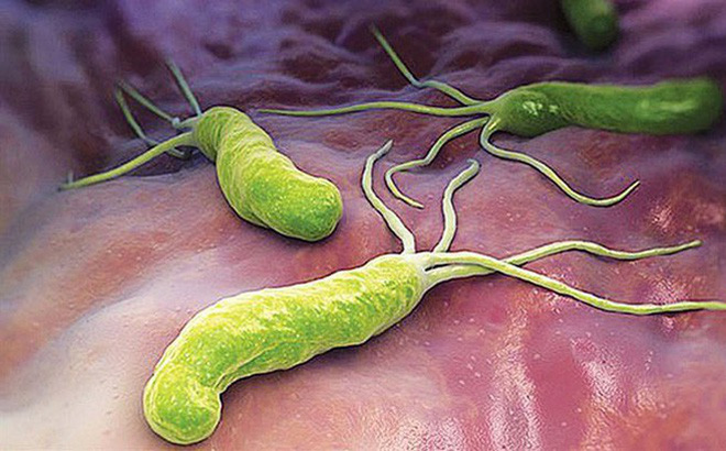 Nhiễm H. pylori (HP) - Ảnh minh họa 5