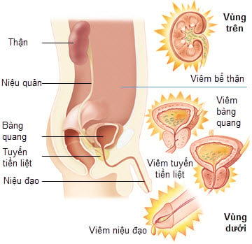 Nhiễm trùng tiết niệu - Ảnh minh họa 5