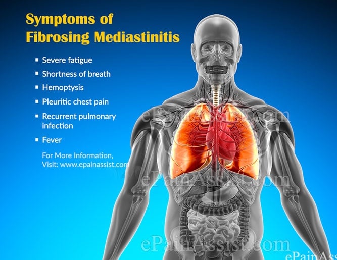 Mediastinitis - Ảnh minh họa 4