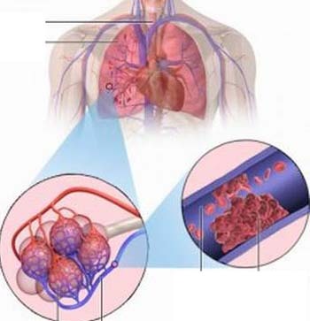 Nghẽn mạch phổi - Ảnh minh họa 5