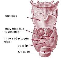 Neurofibromatosis - Ảnh minh họa 4