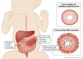 Nhiễm khuẩn Klebsiella - Ảnh minh họa 5