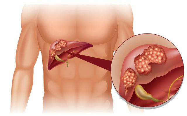 Acute Hepatitis - Ảnh minh họa 3