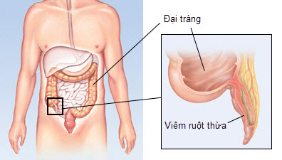 Acute appendicitis - Ảnh minh họa 3