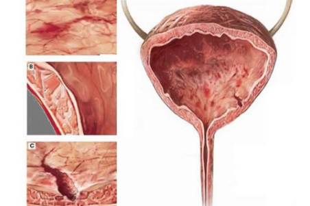 Nhiễm trùng bàng quang - Ảnh minh họa 4