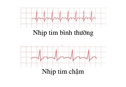 Nhịp tim chậm - Ảnh minh họa 1