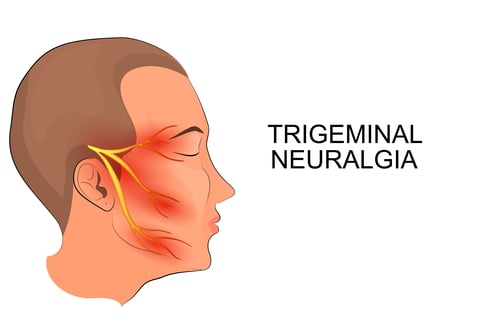 Neuralgia - Ảnh minh họa 4