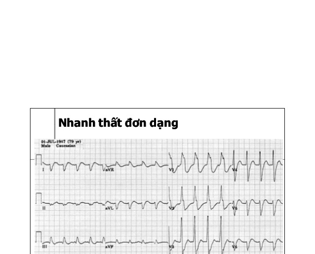 Nhịp nhanh thất - Ảnh minh họa 2