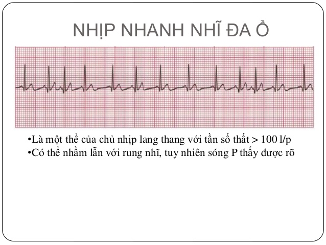 Nhịp nhanh thất - Ảnh minh họa 4