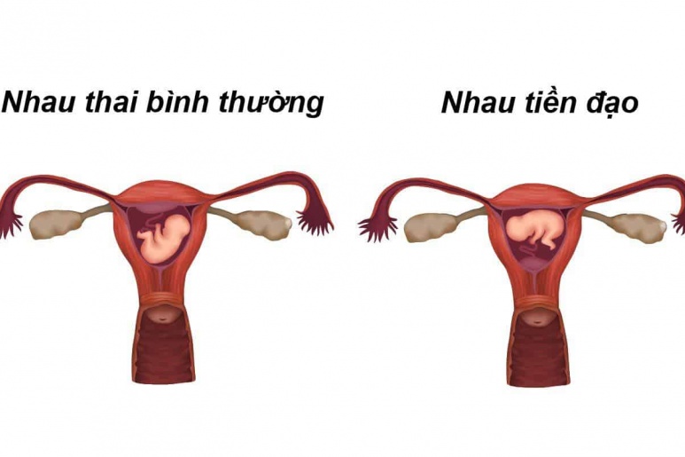 Nhau tiền đạo - Ảnh minh họa 3