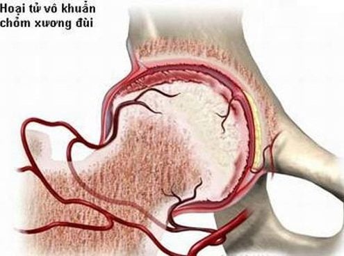 Nhiễm trùng khớp gối - Ảnh minh họa 5