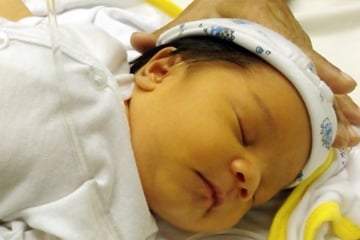 Neonatal Jaundice - Ảnh minh họa 1