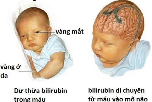 Neonatal Jaundice - Ảnh minh họa 5