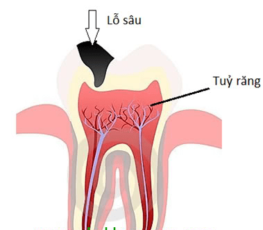 Nội nha - Ảnh minh họa 4