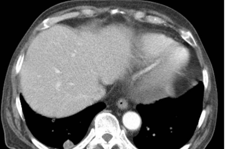 Nhiễm vi khuẩn Nocardia - Ảnh minh họa 2