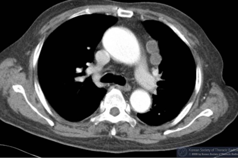 Nhiễm vi khuẩn Nocardia - Ảnh minh họa 3