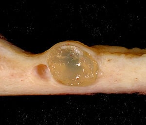 Nabothian Cysts - Ảnh minh họa 1