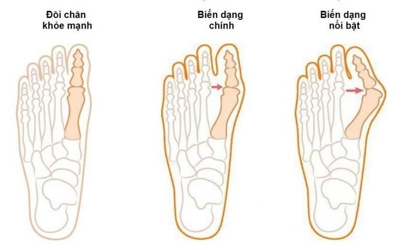 Biến dạng ngón chân cái - Ảnh minh họa 3