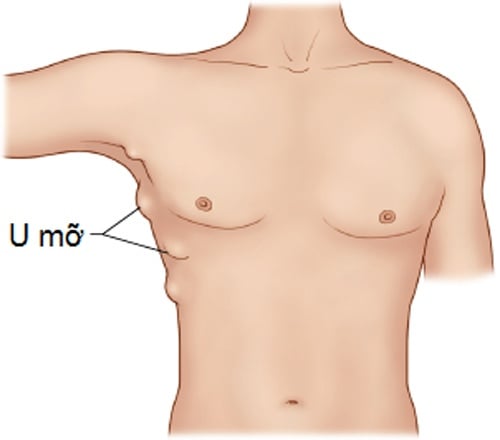 Bướu mỡ - Ảnh minh họa 2