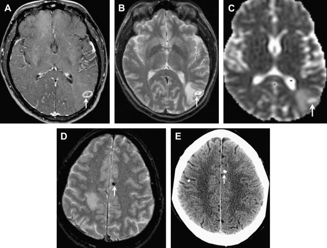 Nhiễm Toxoplasma - Ảnh minh họa 4