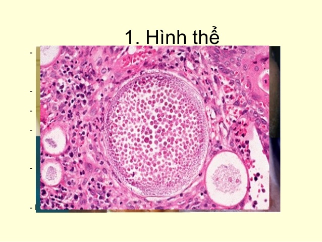 Nhiễm trùng mũi do nấm Rhinosporidiosis - Ảnh minh họa 3