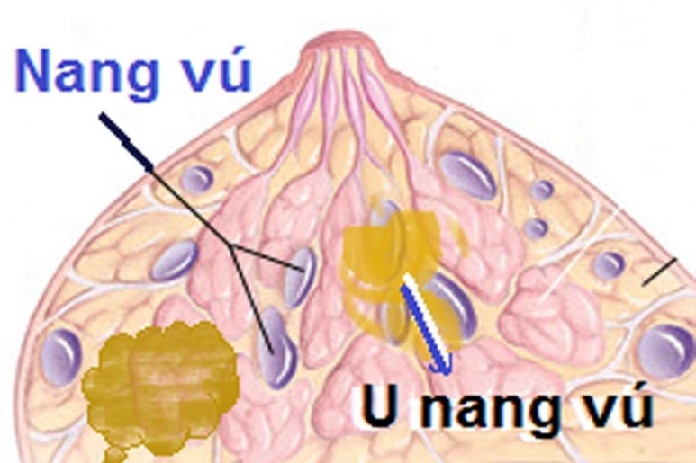 Bướu sợi tuyến vú - Ảnh minh họa 1