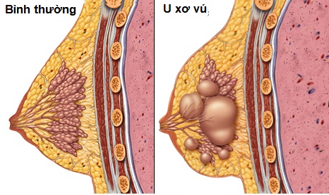 Bướu sợi tuyến vú - Ảnh minh họa 2