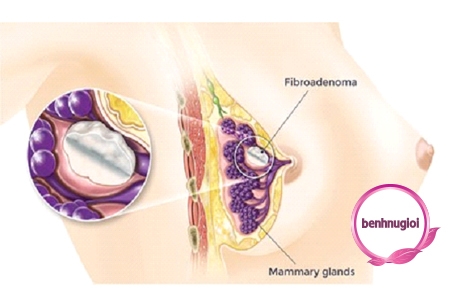 Bướu sợi tuyến vú - Ảnh minh họa 3
