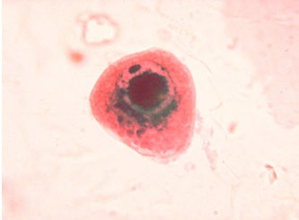 Nhiễm virus Cytomegalo - Ảnh minh họa 1