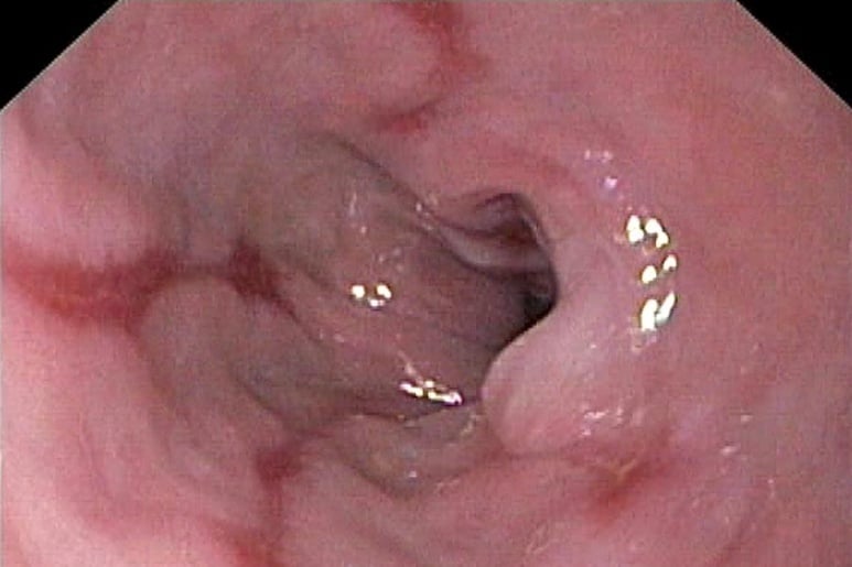 Oesophagitis - Ảnh minh họa 1