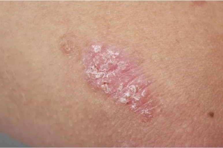 Psoriasis - Ảnh minh họa 2