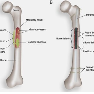 Osteomyelitis - Ảnh minh họa 2