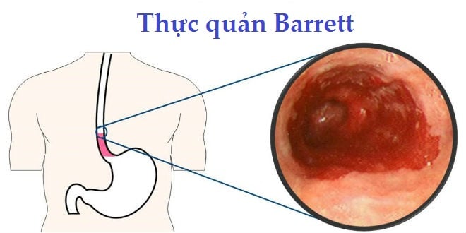 Barrett thực quản - Ảnh minh họa 1