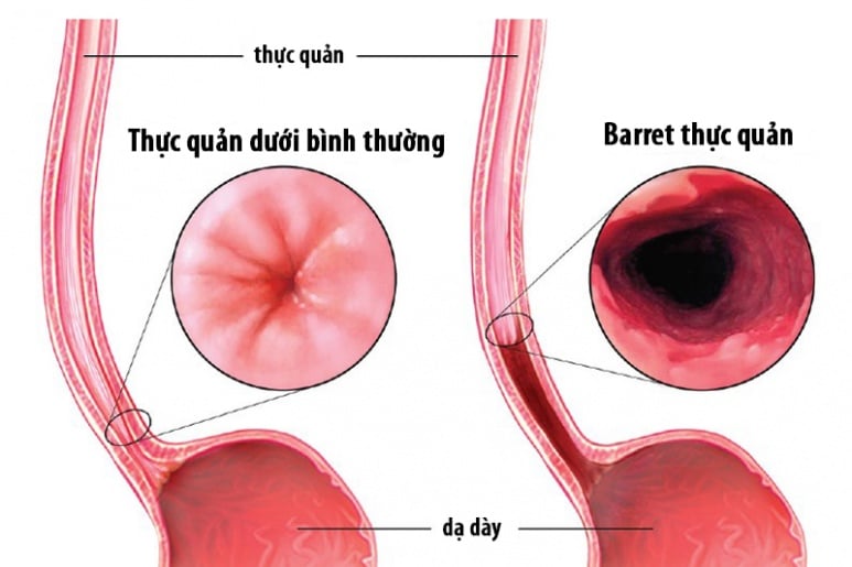 Barrett thực quản - Ảnh minh họa 2