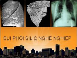 Bụi phổi Silic - Ảnh minh họa 1