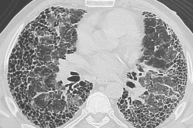 Pulmonary fibrosis - Ảnh minh họa 1