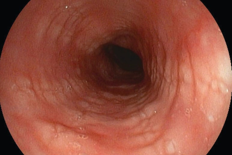 Oesophagitis - Ảnh minh họa 2