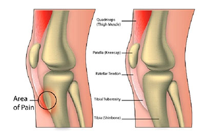 Osgood-Schlatter - Ảnh minh họa 2