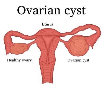 Ovarian Cysts - Ảnh minh họa 4