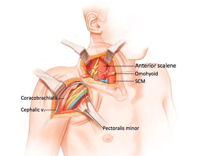 Plexus lesion arm - Ảnh minh họa 2