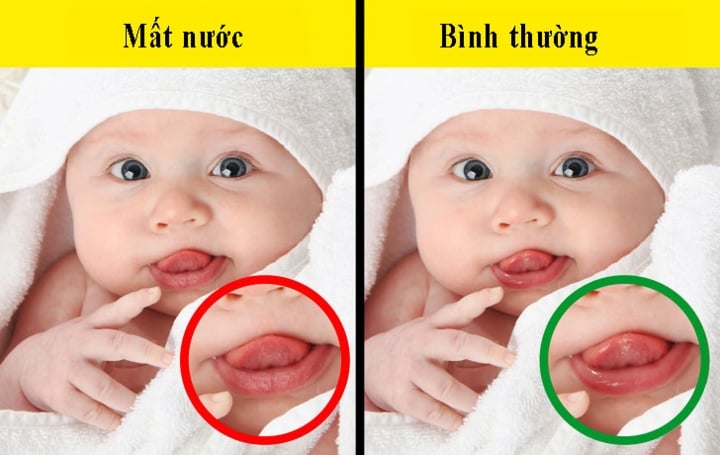 Nhiễm Rotavirus - Ảnh minh họa 1