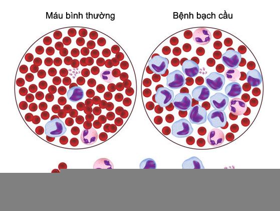 Bạch cầu tủy xương mạn tính (CML) - Ảnh minh họa 2