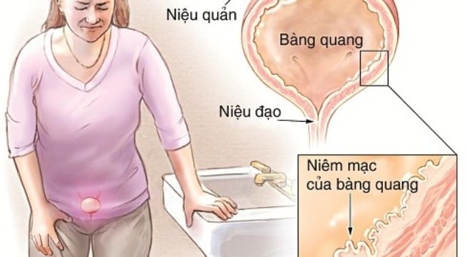 Bàng quang thần kinh - Ảnh minh họa 3