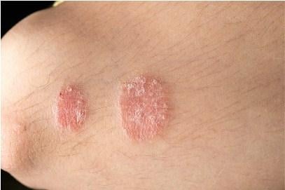 Psoriasis - Ảnh minh họa 3