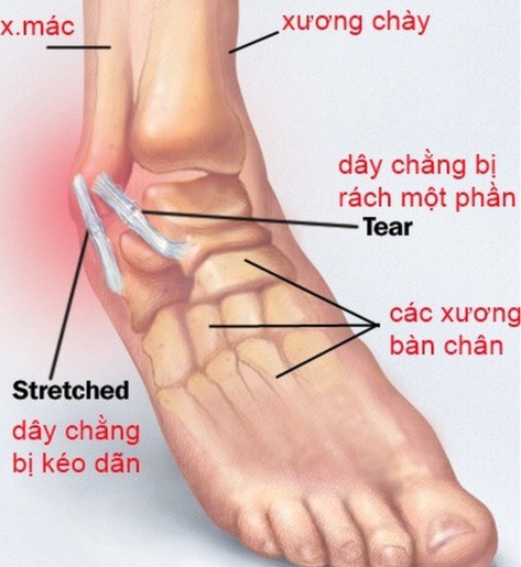 Bong gân mắt cá chân - Ảnh minh họa 3