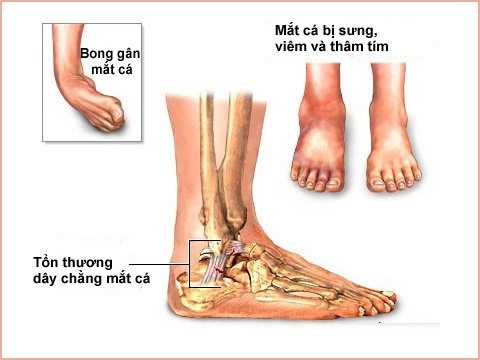 Bong gân mắt cá chân - Ảnh minh họa 4