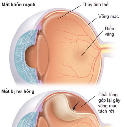 Bong võng mạc - Ảnh minh họa 3