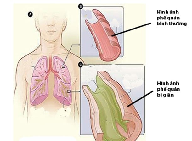 Bronchiectasis - Ảnh minh họa 1